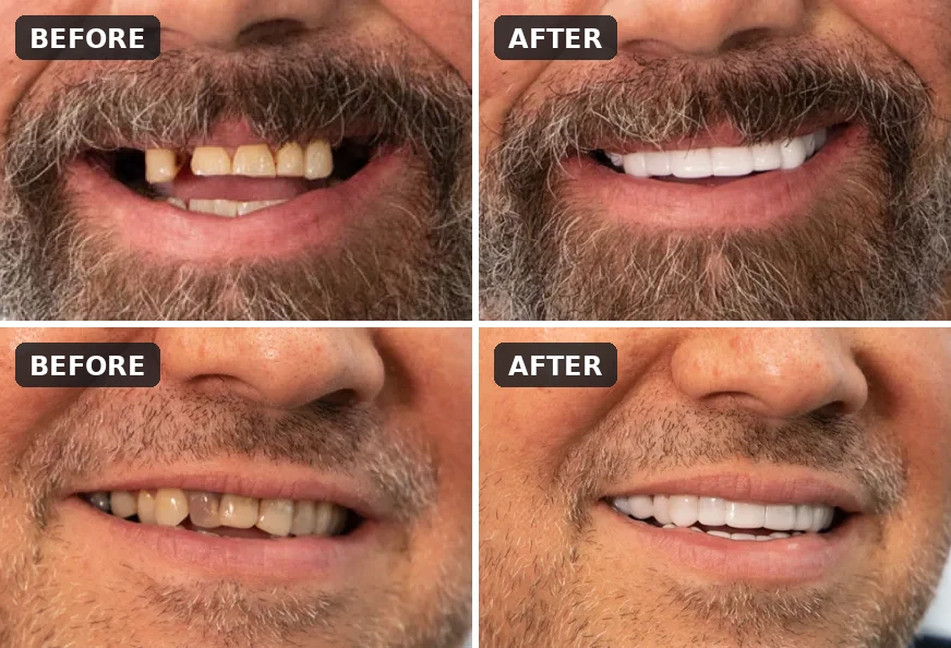 Before-and-after smiles with missing and stained teeth covered by Shiny Smile Veneers